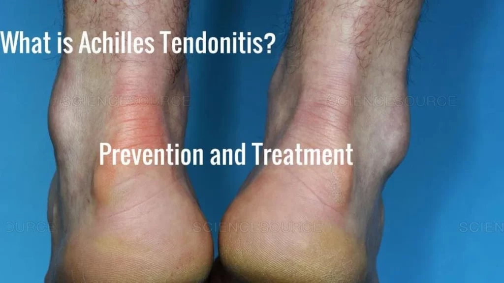 Prevention and treatment of Achilles tendonitis