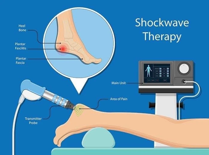 Shockwave therapy for Achilles tendonitis or tenosynovitis