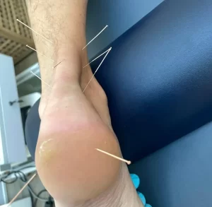 Acupuncture for Achilles tendonitis or tenosynovitis