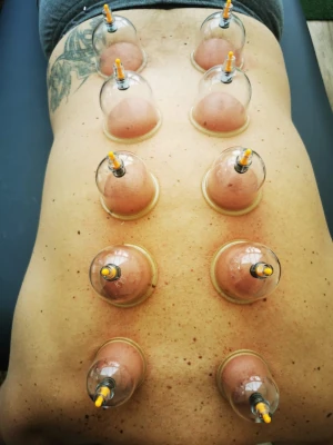 Cupping - front view