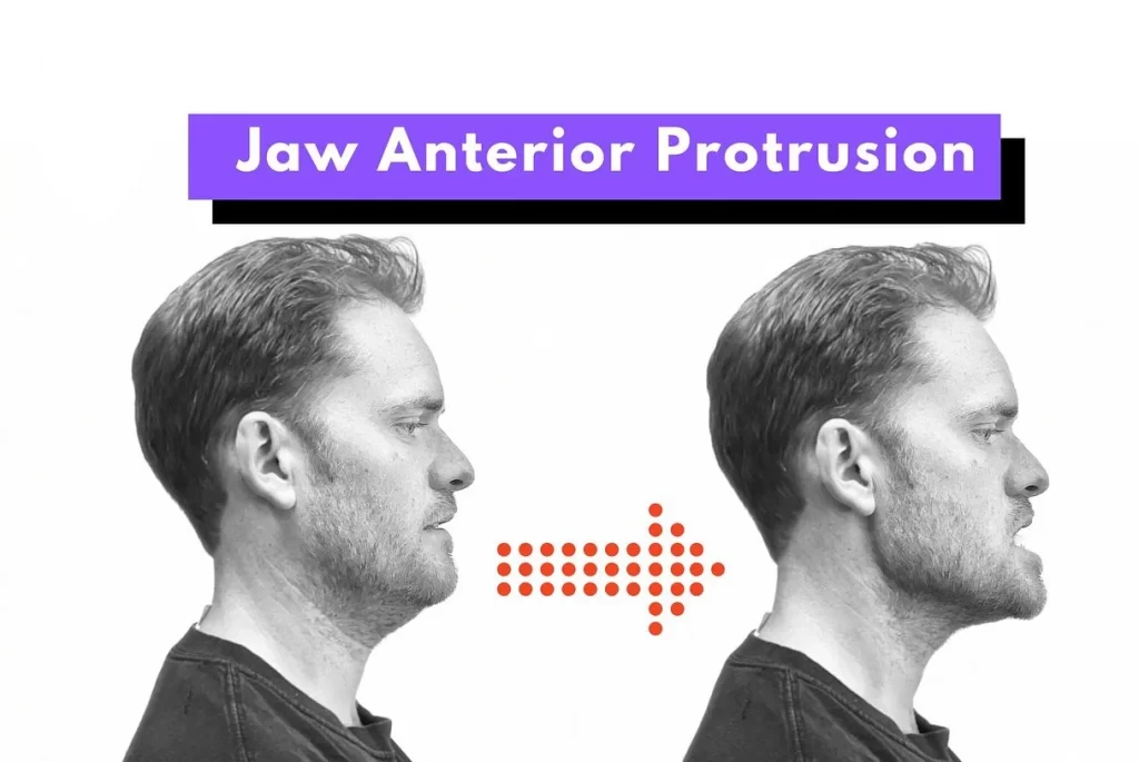 Jaw Anterior protrusion