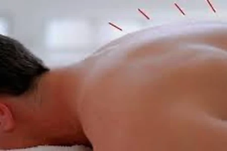 Needles along the spine